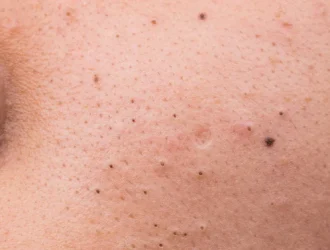 Éliminer les gros points noirs