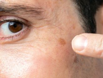 Taches brunes sur la peau