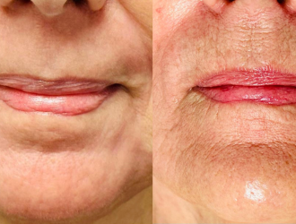 laser fractionné co2