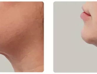 perdre le double menton