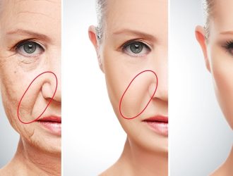 sillons nasogéniens avant après