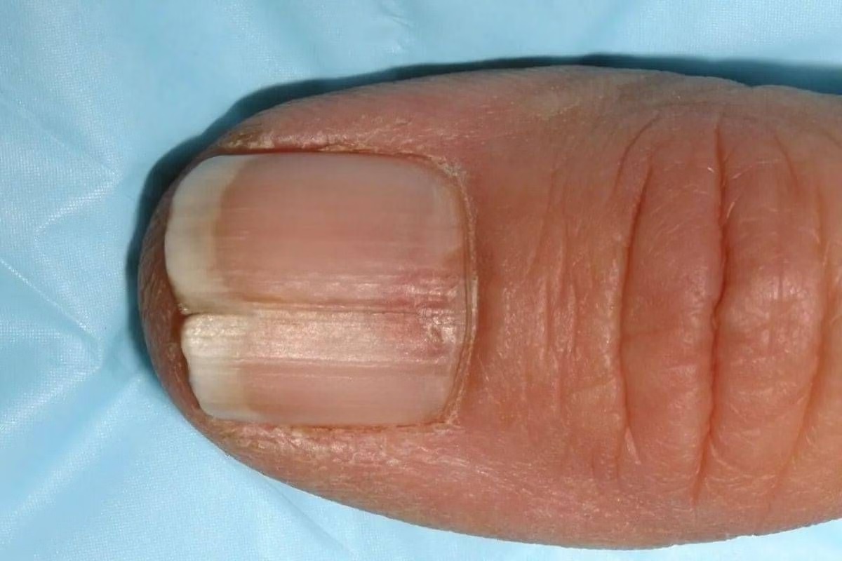 Ongle qui se fend toujours au même endroit