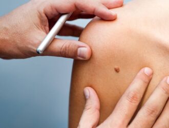 grain-de-beaute-en-relief