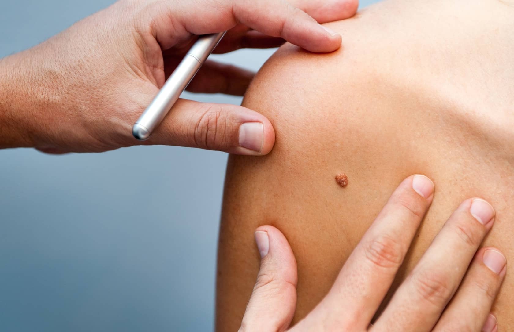 grain-de-beaute-en-relief