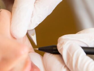 electrolyse-epilation