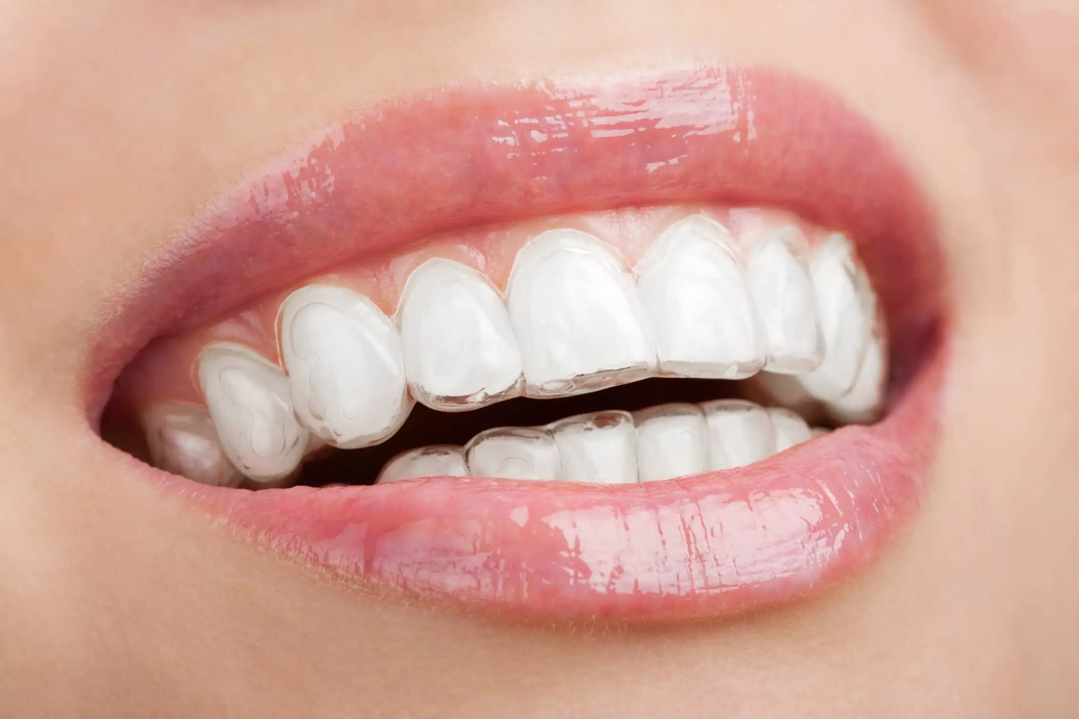 invisalign-prix