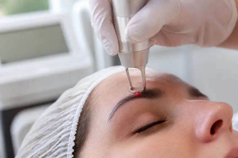 Séance de détatouage sourcils au laser ciblant l'encre de l'arcade sourcilière